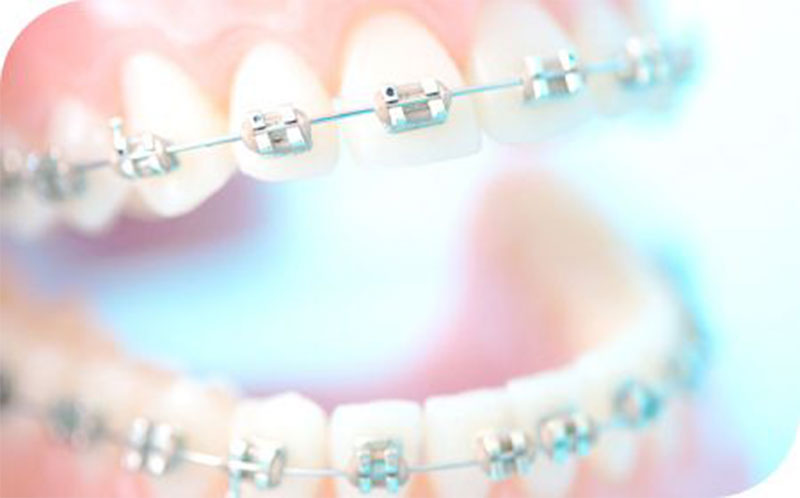 矯正歯科・小児矯正