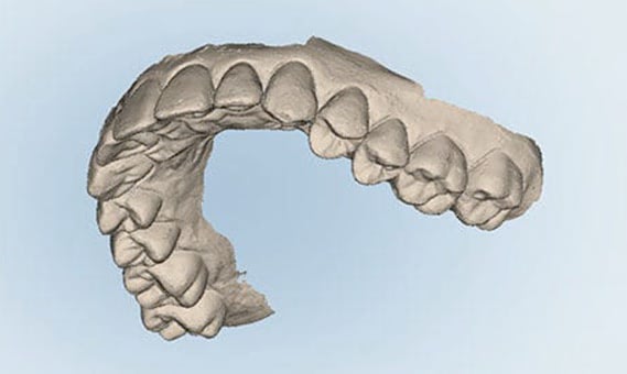 口腔内3Dスキャナー