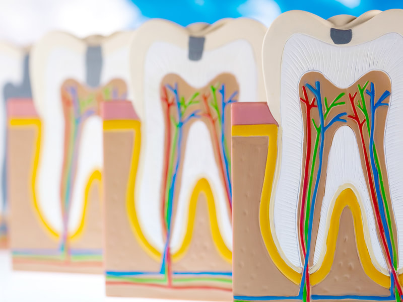 根管治療