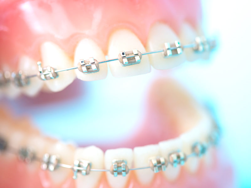 矯正歯科・小児矯正