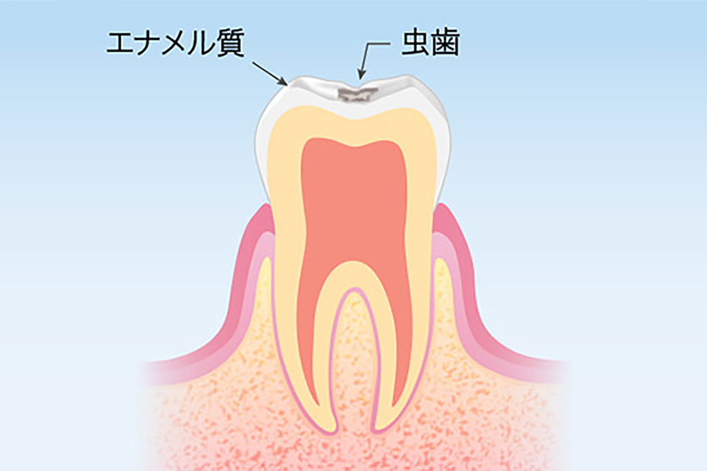 むし歯の原因は？
