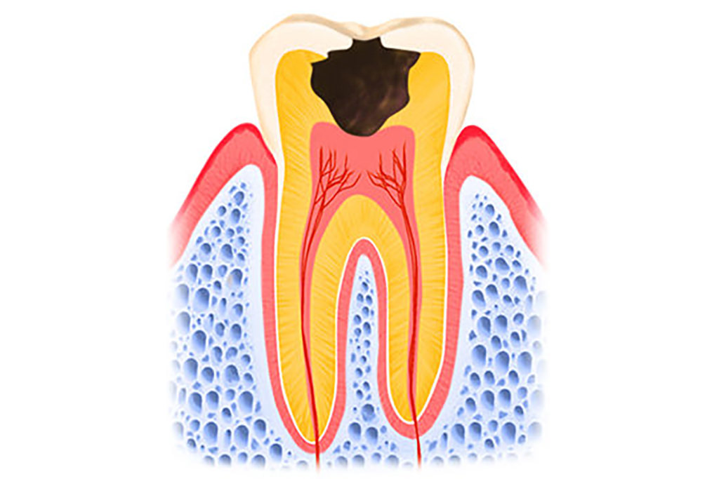 神経まで進行したむし歯(C3)