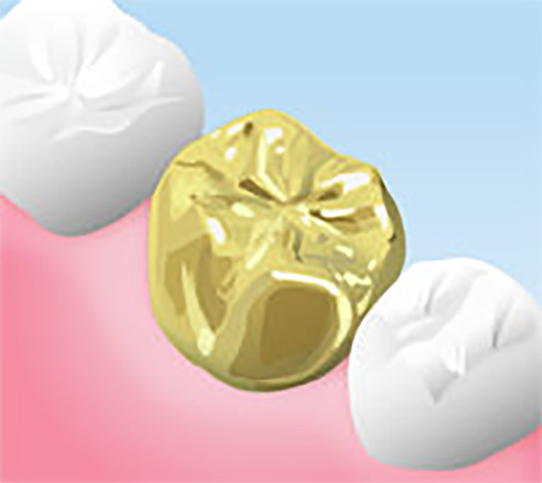 ゴールドの詰め物・被せ物